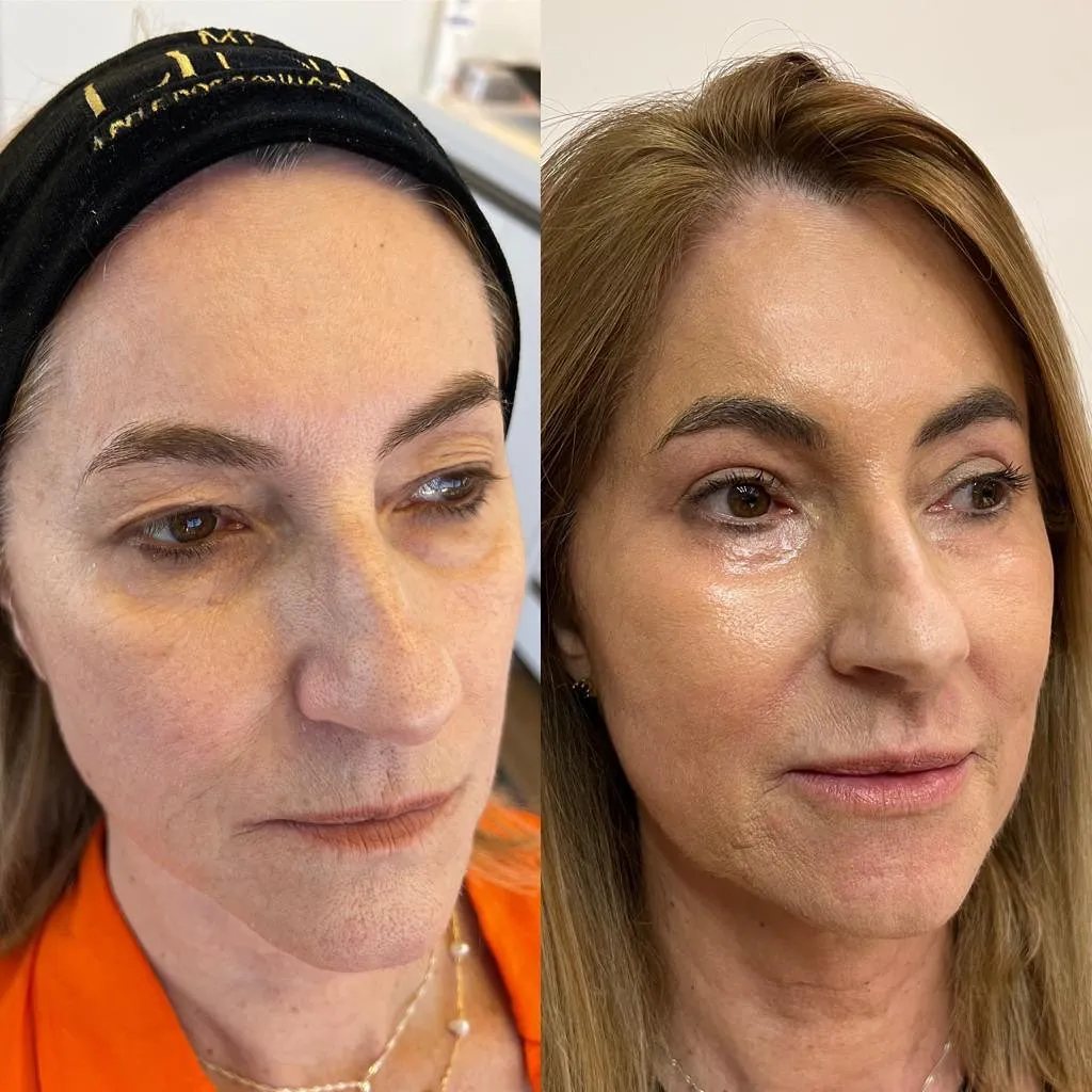 Antes e depois — resultado real 1