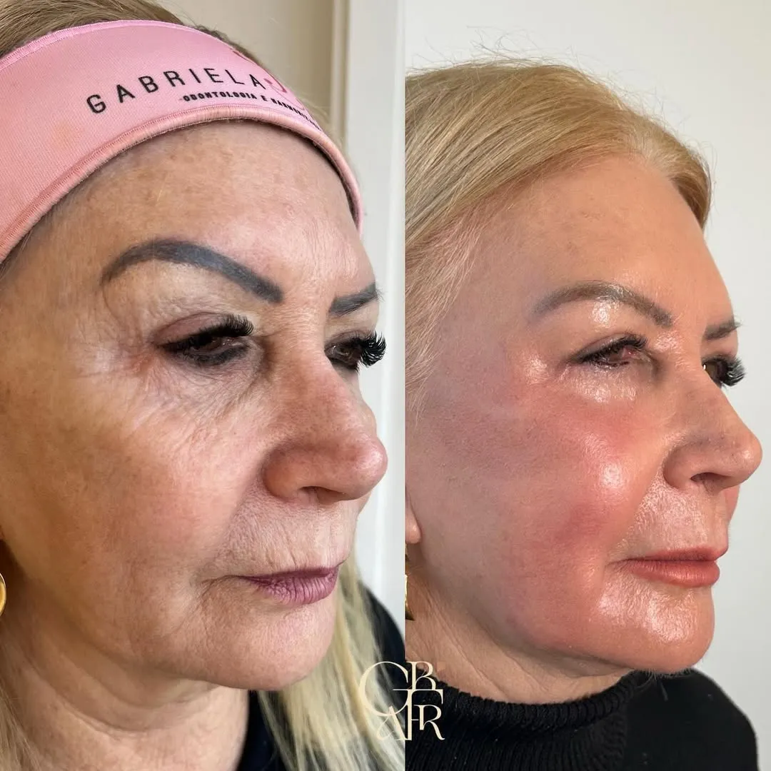 Antes e depois — resultado real 2