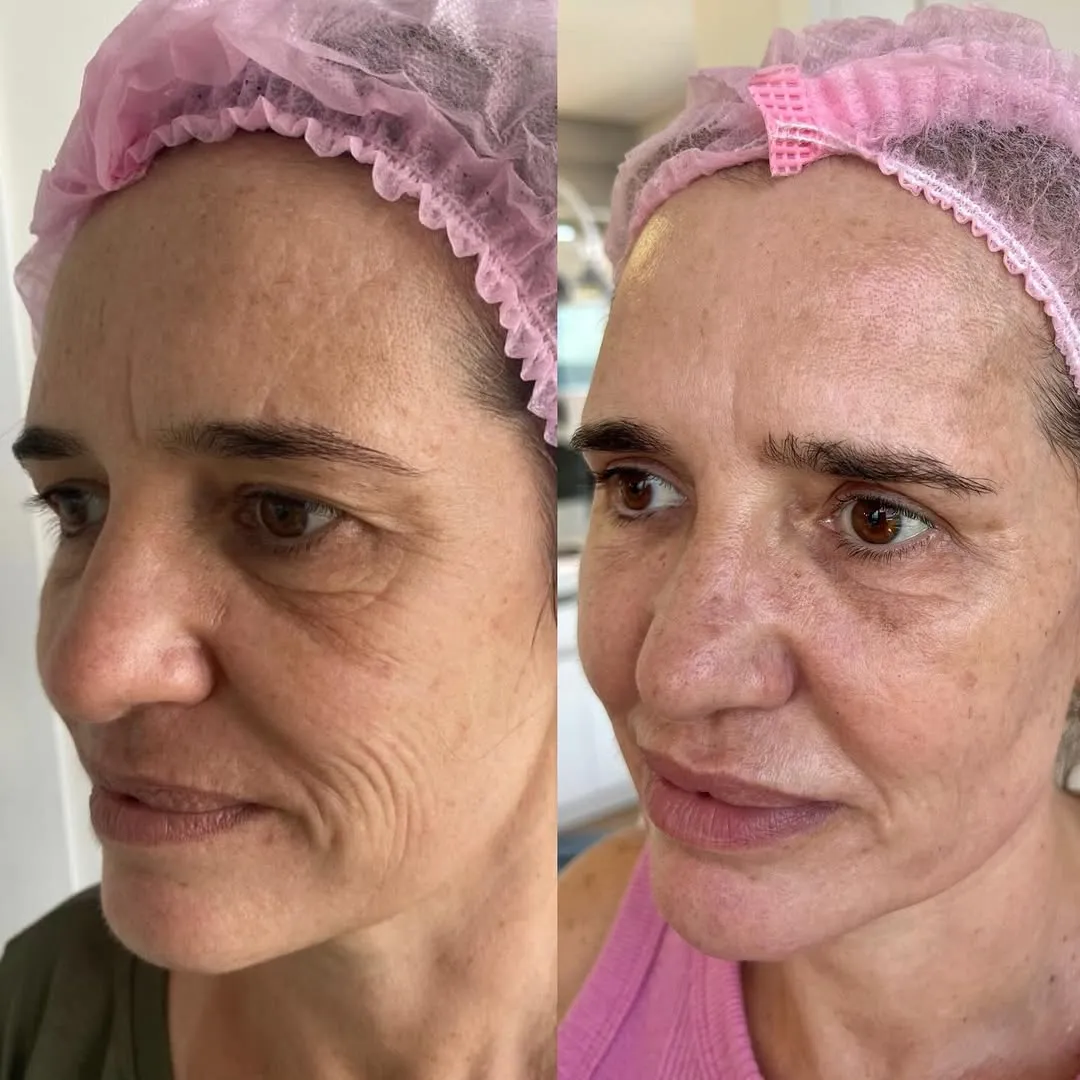 Antes e depois — resultado real 4